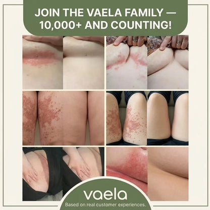 Vaela Anti-Friction Stick™ | Relieves Pain and Redness in 2 Minutes
